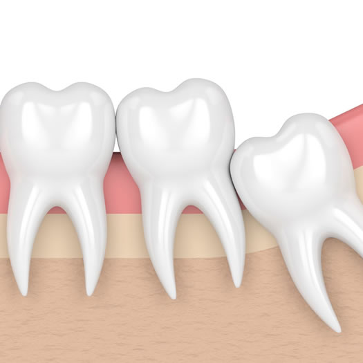 Dentes Inclusos