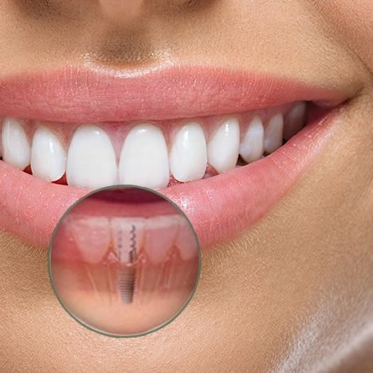 Implantes Dentários